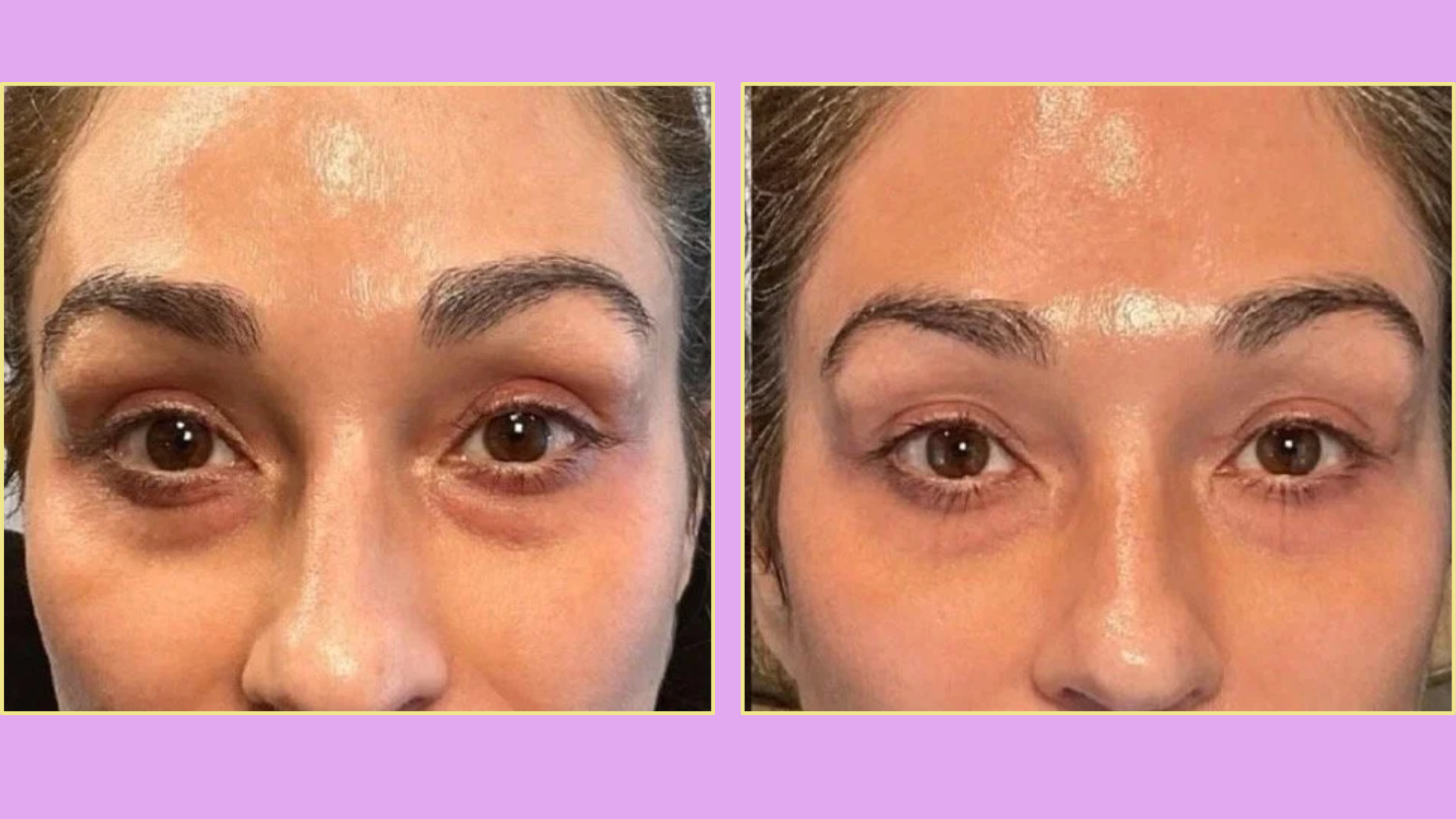 what is prp under eyes its benefits side effects and procedure